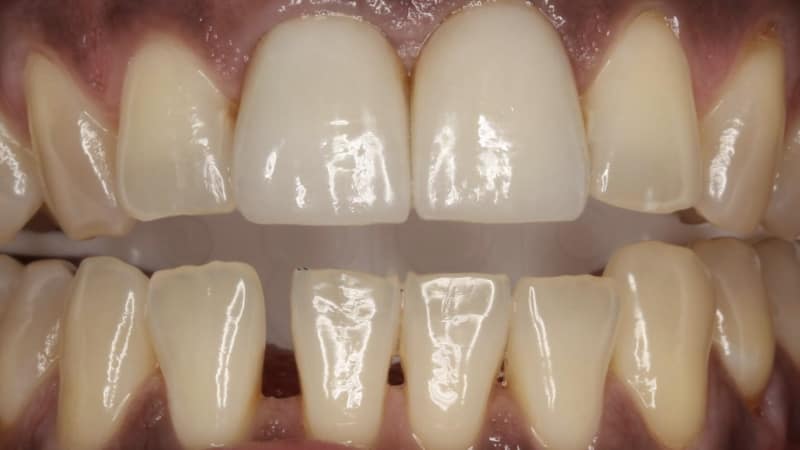 after-crown-image after-crown-image