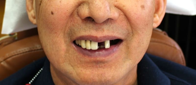 denturepre denturepre