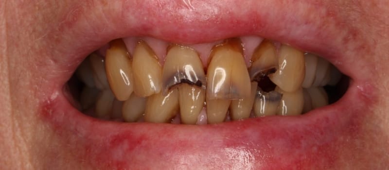 fillingpre fillingpre