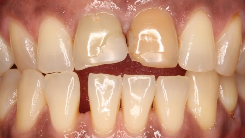 img_5412_dxo teeth whitening services