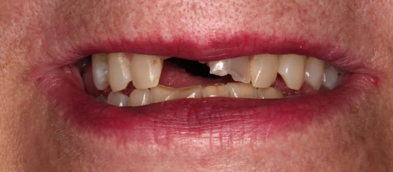 img_5497_dxo Crowns and Bridge