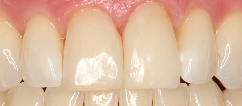 img_5707_dxo Cosmetic Dentistry Services