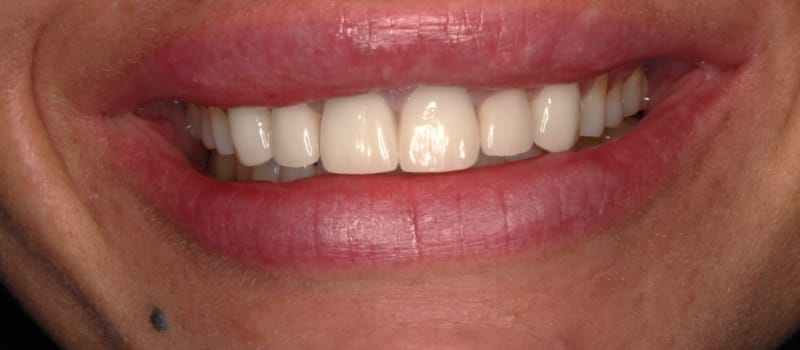 veneerpost veneerpost