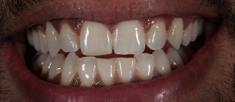 whiteningpre whiteningpre